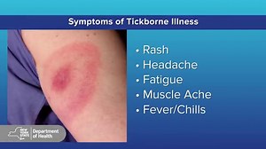 Lyme Disease and Other Diseases Carried by Ticks