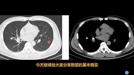 肺部基本病变影像：钙化在CT上的表现，常见于哪些疾病？