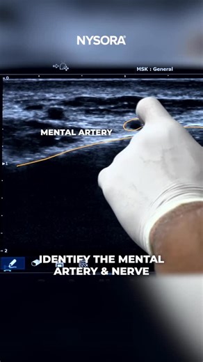 NYSORA Inc. on Instagram: "A 52-year-old patient presents with burning, tingling pain and allodynia of the chin and lower lip, consistent with mental neuralgia. An ultrasound-guided mental nerve block is performed to relieve pain and confirm the diagnosis. Dr. Sadiq Bhayani demonstrates how to perform this intervention. Key steps: - Position: Supine, mouth slightly open, jaw relaxed - Scanning: Transducer ~3 cm lateral to midline, 1 cm above lower mandibular border (between first & second premol