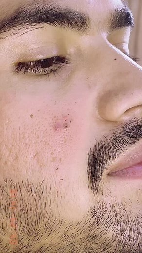 Ingrown Hair Removal Techniques for Men