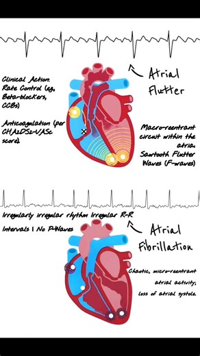 Abdallah Othman on Instagram: "Atrial Flutter vs. Atrial Fibrillation: ECG Guide ⚡📈 🔁 Atrial Flutter · Rhythm: Regular · Atrial Waves: Sawtooth “F” waves · Rate: 250–350 bpm · P-Waves: Absent, replaced by flutter waves · Key: “Organized chaos” 📉 Atrial Fibrillation · Rhythm: Irregularly irregular · Atrial Waves: Erratic, low-amplitude “f” waves · Rate: 350–600 bpm · P-Waves: Absent · Key: “Disorganized chaos” 💡· Both rhythms often coexist and may transition within the same atrial substrate. 