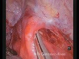 Single-port Thoracoscopic Resection of Complex Mediastinal Cystic Mass • Video • MEDtube.net