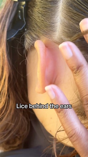 Lice tend to gather behind the ears because the area provides extra warmth — the perfect cozy spot for them to hide. #explore #momlife #school #lice #piojos | Stacey The Louse Lady