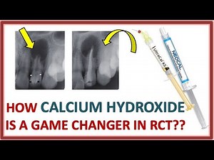 How CALCIUM HYDROXIDE is a GAME CHANGER in RCT // CAOH // ENDODONTICS // DENTAL EDUCATION
