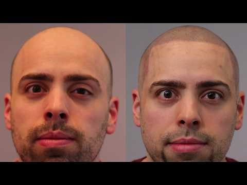 Before + After Scalp Micropigmentation | Matt Visits Hairline Ink Chicago