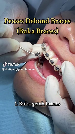 Proses Debond Braces (Buka Braces)