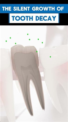 How does tooth decay spread?
