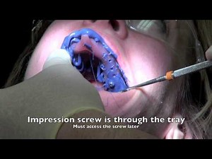 Dental Implant - Impression and Insertion of crown • Video • MEDtube.net