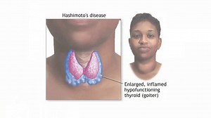 A Comprehensive Guide To Goitrogens and Hashimoto's