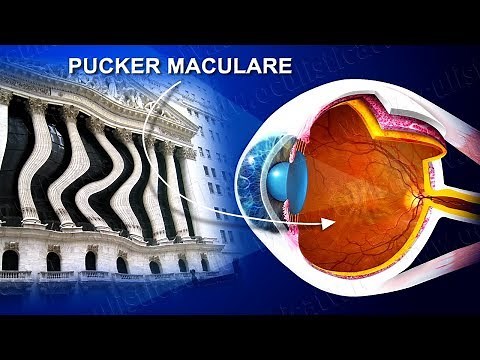 Macular pucker surgical treatment (www.oculisticaTV.it)