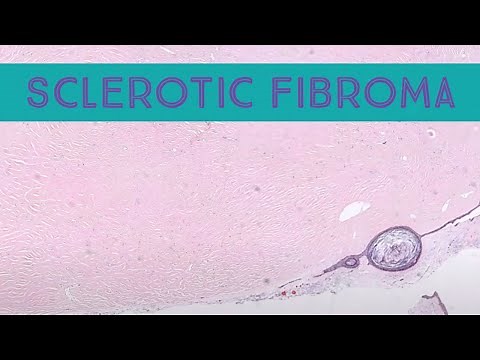 Sclerotic fibroma (storiform collagenoma/plywood fibroma) pathology dermatology dermatopathology