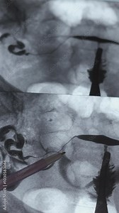 X-ray image of Hysterosalpingography (HSG). MRI with contrast agent. Patency of the uterus, ovaries and fallopian tubes. Uterine tubes, analysing female reproductive system. Infertility treatment.