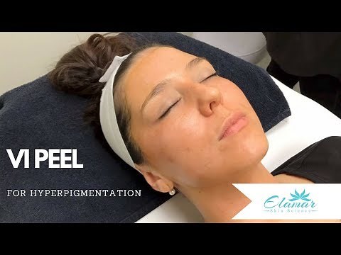 VI Peel® | Chemical Peel for Hyperpigmentation