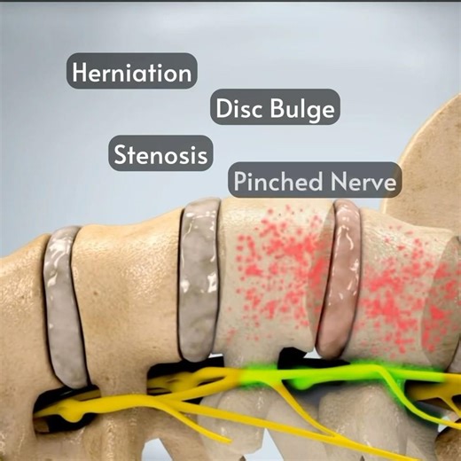 Discover How Accu-SPINA Spinal Decompression Software Relieves Sciatica, in Just 30 Seconds