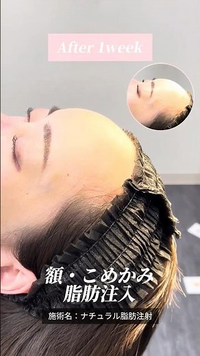 脂肪注入(額・こめかみ)の3症例📝 #イテウォンビューティークリニック大阪心斎橋院 #sbc #湘南美容クリニック #美容整形 #脂肪注入 #美容 #整形 #垢抜け #ダウンタイム