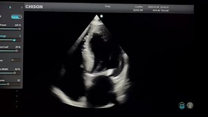 Video del equipo SonoAir 70 con transductor sectorial. Siempre buscamos ofrecer la mejor calidad y equipos de última generación con tecnologías de alta gama. Recuerda que si te interesan nuestros equipos puedes contactar a cualquiera de nuestros distribuidores autorizados en tu país. Síguenos en nuestras redes sociales: IG https://instagram.com/chison_mexicooficial?igshid=MzRlODBiNWFlZA== TikTok https://www.tiktok.com/@chison.mxico.ofic?_t=8gCqgTfoDKP&_r=1 Facebook https://www.facebook.com/Chiso