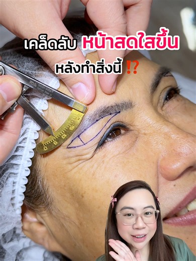 เคล็ดลับ หน้าสดใสขึ้น หลังทำสิ่งนี้ ⁉️👀#หมอเฟิร์นfernclinic #subbrowlift #ตาสวย #ศัลยกรรม #เทรนด์วันนี้