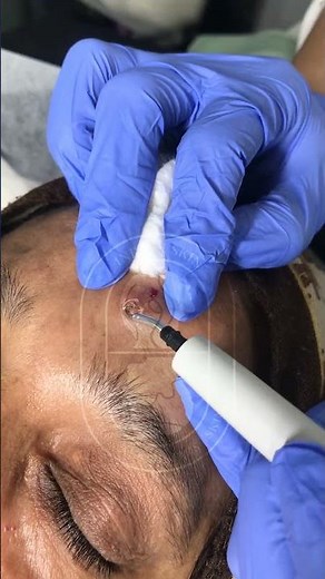 Skin Tag removal using electrocautery #hyfrecator #electrocauterysurgery