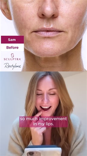 Sculptra on Instagram: "Halfway through their journeys, and the results are already showing: firmer skin, refined features, and a fresher look. Our patients couldn’t be happier, and the best is yet to come. Always consult a healthcare professional for individualized treatment recommendations and to discuss important safety information and risks associated with the use of the products. #weareallsculptra #provenresults #skinrenewal #firmerskin"