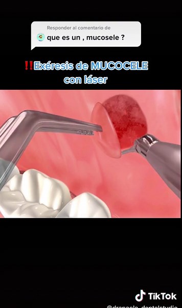 Mucocele Bucal: Cómo Identificar y Tratar