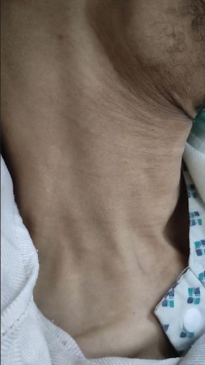 Corrigan's sign ( bounding carotid pulsation ) in severe Aortic Regurgitation