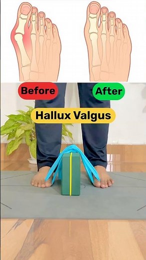 Fix Flat Feet & Hallux Valgus | Stop Knee & Back Pain from the Root