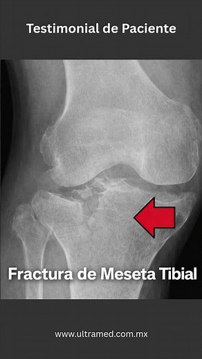 Fractura Tibial como se recupera - #fisioterapia #rehabilitacionfisica #fractura