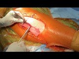 THA: 3 Layer Closure Using Quill Barbed Suture • Video • MEDtube.net