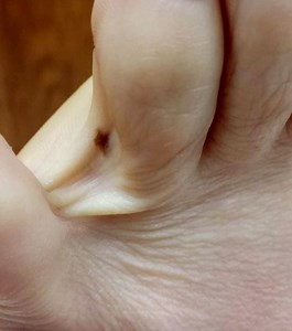 What is nail melanoma? 21-year-old details spotting skin cancer on nail