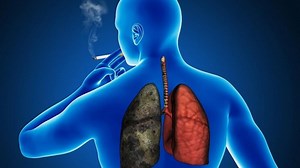 Află tot ce trebuie să știi despre CANCERUL PULMONAR - diagnostic și TRATAMENT