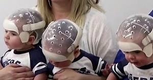 Birth Defect Makes Triplets Among Most Rare In Medical History