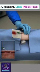 248K views · 967 reactions | Arterial line insertion #fbreelsfypシ゚ #arterialline #medical #animation #foryou | Medical Animation Media | Facebook