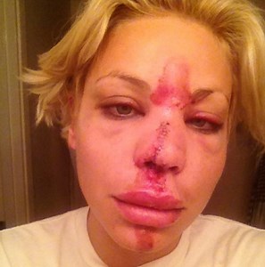 Lisa D'Amato - Défigurée à la suite d'un accident - Hollywoodpq.com