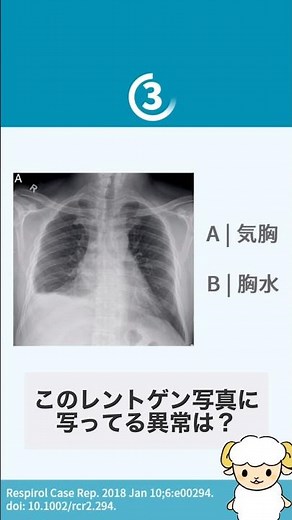 【呼吸器内科が40秒で解説】胸水のレントゲン
