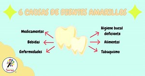 Los dientes amarillentos son uno de los problemas de estética dental...