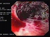 Acute Variceal Bleeding - Visualization of Bleeding • Video • MEDtube.net