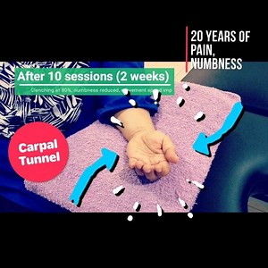 19 reactions · 16 shares | NO SURGERY RECOVERY - CARPAL TUNNEL...