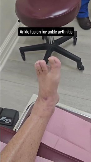 Arthroscopic Ankle Fusion Success by Dr. Kevin Lam: Minimal Incisions, Maximum Mobility!