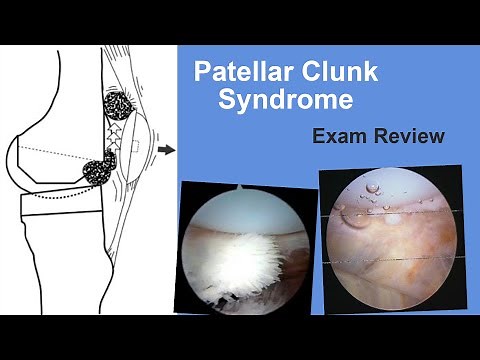 Patellar Clunk Syndrome Exam Review - Matt Austin, MD