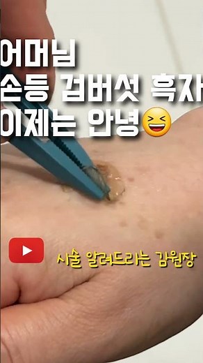 손등 검버섯 흑자 제거 가능? #흑자치료 #리팟레이저 #어븀야그