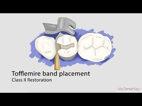 Tofflemire matrix band placement | My Dental Key