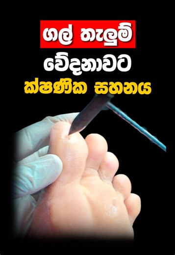 ගල් තැලුම් වේදනාවට ක්ෂනික සහනය ඔබත් දෙස් විදෙස් රටක රෝගයක් නිසා පීඩා විදින අයෙක්ද? 🦠 ඔබට පවතින රෝගී තත්වයන් 100%ක් නිවැරදිව හඳුනා ගනිමින් ඒ සදහා Ayurveda, Siddha, Unani, හෙල යන වෛද්‍ය විද්‍යාවන්ගේ දක්ෂතම වෛද්‍යවරු 1000ක ගේ සාර්ථක කල ප්‍රතිකාර ලබා ගැනීමට අදම Ceylon Hospital වෙත පැමිණ හෝ වෙබ් පිටුව හරහා Physical සහ Online Channelling කරගැනීමේ හැකියාව ඇත. 📅 පැමිණීමට පෙර ඔබට ගැලපෙන වෛද්‍යවරයන්, ප්‍රතිකාර, පහසු කාලයන්, දිනයන්, මිල ගණන් සහ අවශ්‍ය නේවාසික පහසුකම් වෙන් කරවා ගැනීමට අදම අප හා සම්බන්ද වන