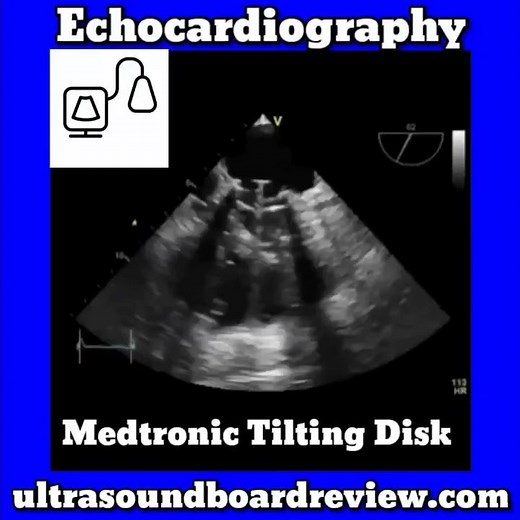 Medtronic Tilting Disk