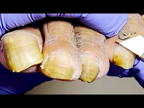 Onychomycosis + Foot Calluses + Dead Skin, Complete Cleaning【Podiatry Clinic】