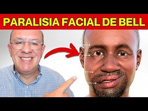 Bell's Facial Palsy [Complete Lesson]: How to Identify It? Symptoms, Diagnosis, and Treatment
