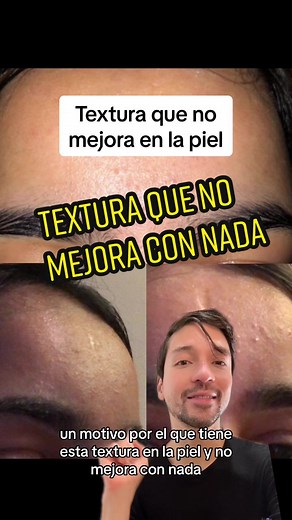 Muchas veces la textura que no mejora es acné fúngico #skincare #skincaretips #acne #acnefungico #fungalacne #textura #texturaenlapiel #pityrosporumfolliculitis #malazessia #azelaico #ketoconazol #doblelimpieza #limpiezafacial #barreracutanea #greenscreen