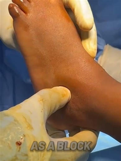 🦶🔩 How we correct flat feet in children: Arthroereisis explained In flexible flat feet, the arch collapses because the heel drifts into valgus and the talus over-pronates. Arthroereisis is a minimally invasive technique where a small implant (screw or device) is placed in the sinus tarsi to limit excessive pronation and guide the foot back into alignment. The most commonly used method is the calcaneal stop screw: 🔹 It acts as a mechanical block to stop heel valgus 🔹 It allows the arch to ref