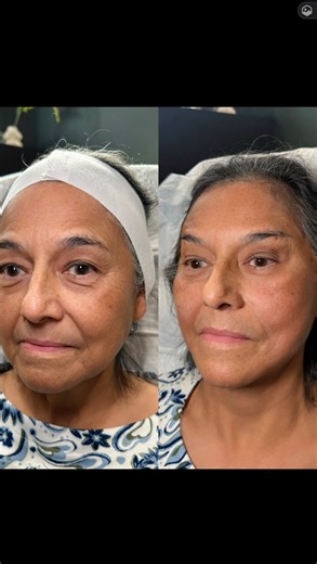 Mary Moosavi, DNP, APRN, CRNA on Instagram: "✨ Did you know? PDO thread lifts don’t just lift, they stimulate your body’s own collagen for months after treatment. 💉 Procedure: PDO Thread Lift ⏰ Appointment time: ~60–90 minutes 💰 Cost: Varies by treatment plan $1500+ 🤍 Pain Management: Local anesthesia 📅 Downtime: Mild swelling, tenderness, or bruising for a few days 📆 Longevity: Progressive collagen production with results lasting ~12 months + 👩🏻‍⚕️ Provider: Goldie Ramos, NP (providers m