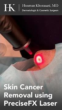 Superficial Skin Cancer Removal using PreciseFX Ablative Laser by Dr. Hooman Khorasani