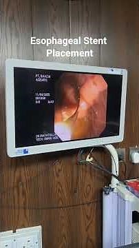 Esophageal Stent Placement | Life-Saving Endoscopic Procedure | Endo Tech by Umar